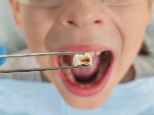 Best Emergency Dental Care for Broken or Chipped Teeth in Muscle Shos, AL